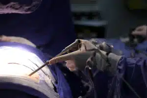 Cirurgia Minimamente Invasiva da coluna em novo hamburgo